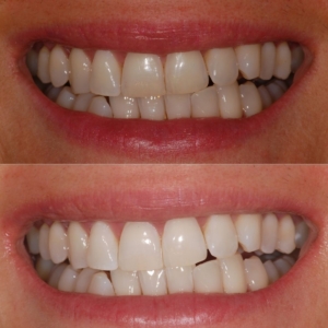 Teeth Whitening | Thames Dental & Facial Care | Surrey