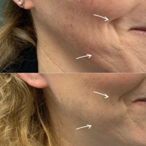 profhilo-treatment-before-and-after-thames-ditton