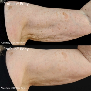 profhilo-treatment-arms-thames-ditton